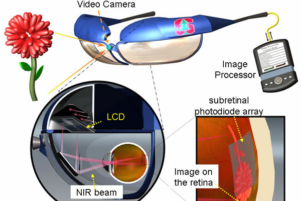 Schema di funzionamento delle protesi oculari fotovoltaiche